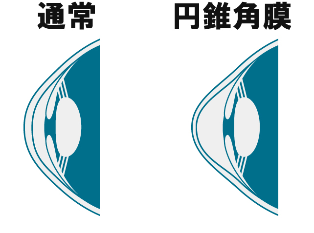 角膜形状解析のイラスト